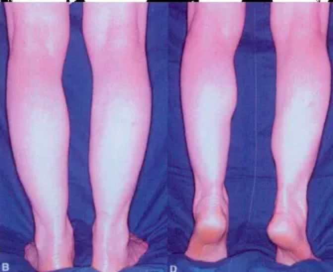 右小腿术后比目鱼肌凸起包块。图片来源：Compensatory hypertrophy of calf muscles after selective neurectomy