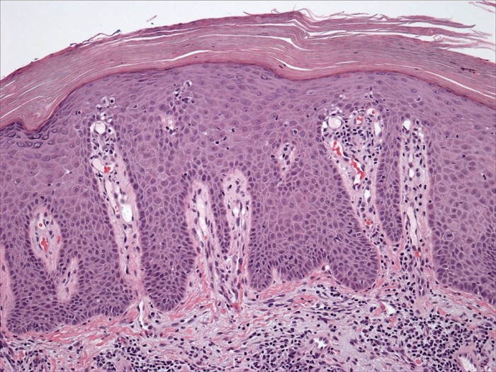 调查称对银屑病和银屑病关节炎患者进行的COVID-19研究存在较高偏倚风险