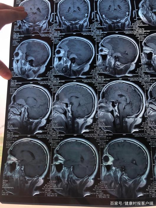 求助:商丘隔离人员复发脑膜瘤病情严重,多方积极协调解决