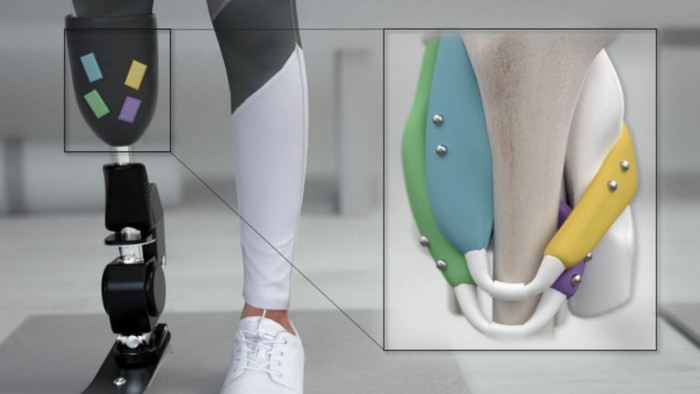 磁铁有助于改善对仿生假肢设备的控制