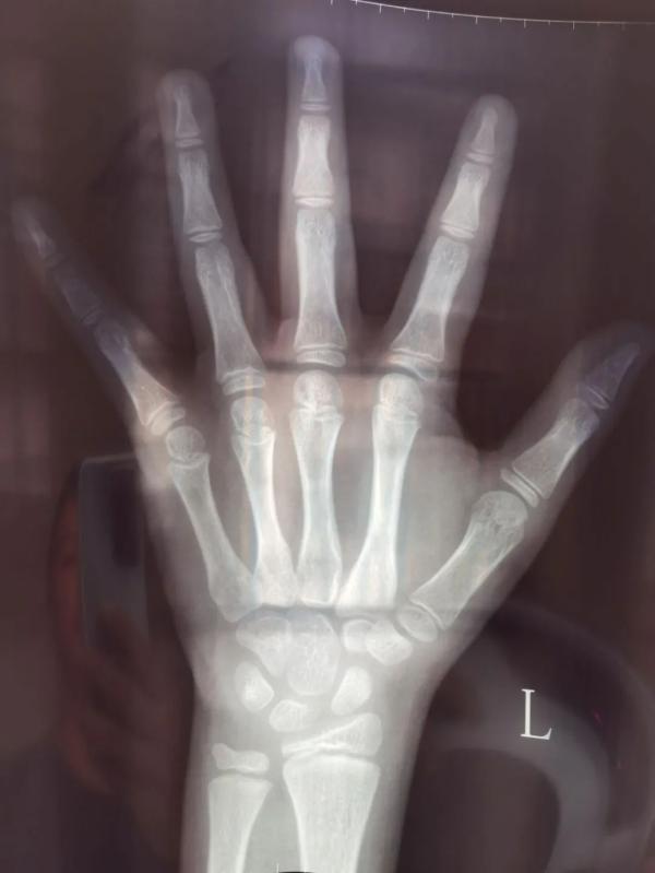 x光骨龄片/图源:受访者