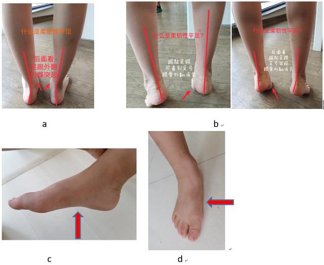 宝宝走路总是脚痛又常摔跤扭伤可能是平足