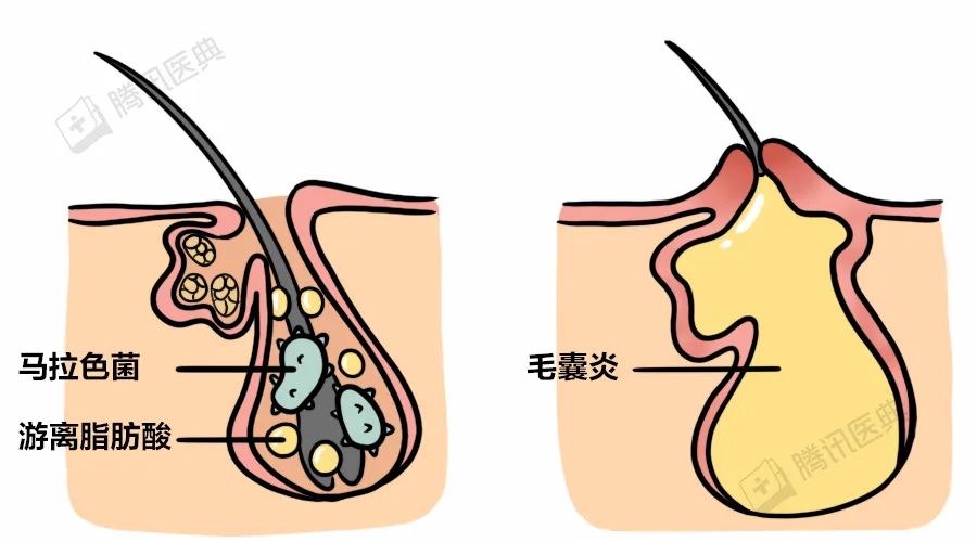 很多人喜欢抠头皮上的小颗粒到底是什么东西