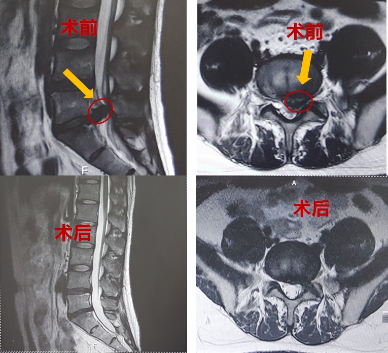 7毫米小切口 修 腰椎 松江这项微创手术帮助腰椎间盘突出患者解除痛症 腰椎间盘突出 新浪财经 新浪网 7毫米小切口 修 腰椎 松江这项微创手术帮助腰椎间盘突出患者解除痛症 腰椎间盘突出 新浪财经 新浪网