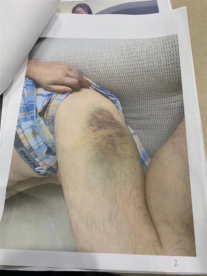 王女士父亲大腿被打淤青