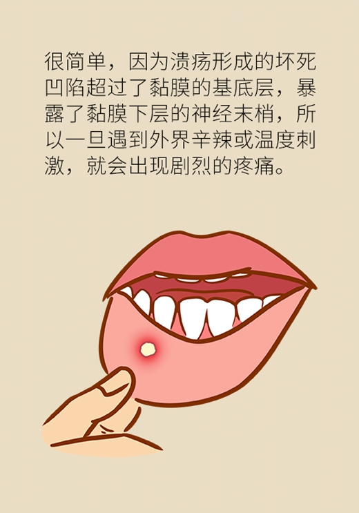 口腔溃疡反复发作或是大病先兆,快去这些科室检查
