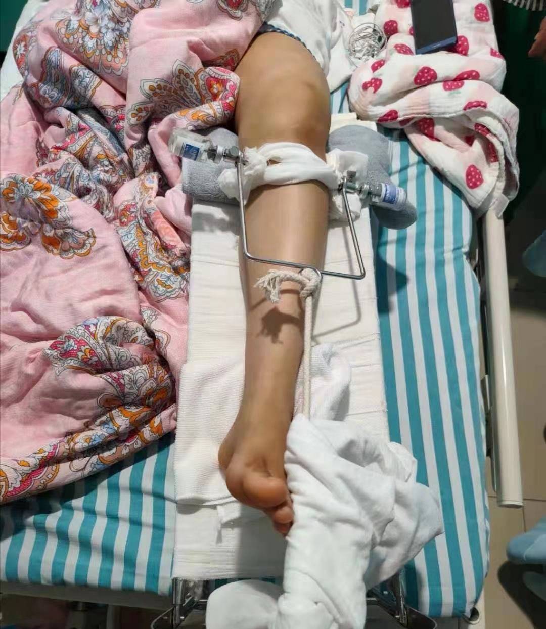 女子瑜伽课被教练压腿至粉碎性骨折因协商无果已委托律师起诉