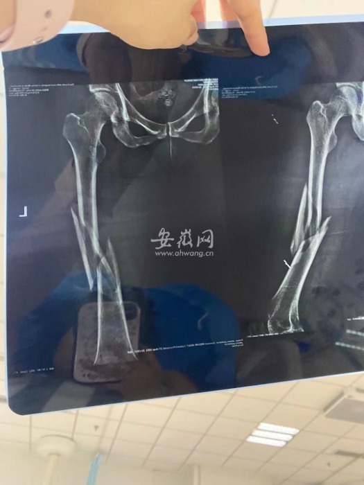 合肥一女子上瑜伽课被教练压断大腿店家通过法律途径解决