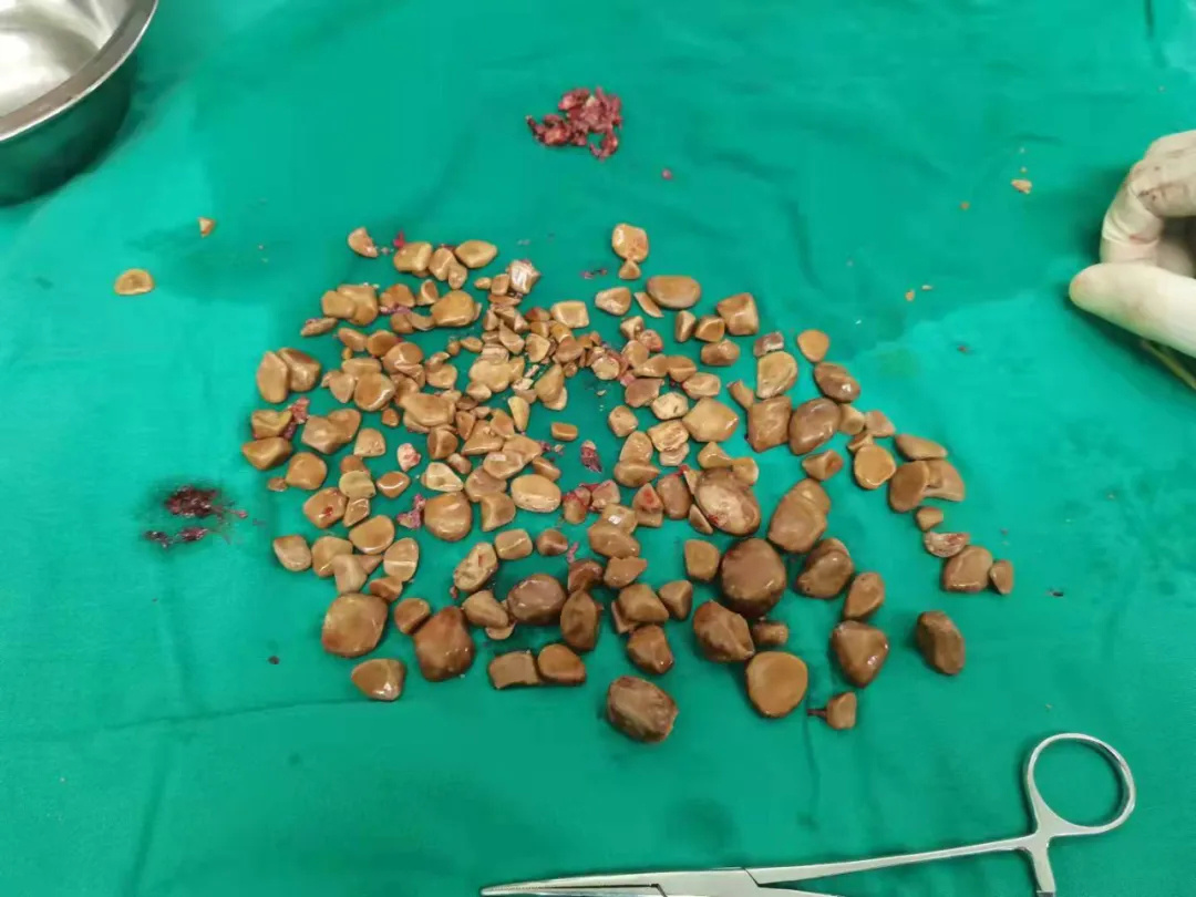 金山有位大叔膀胱藏了近200颗石子,掏出耗时1个多小时|结石_新浪财经