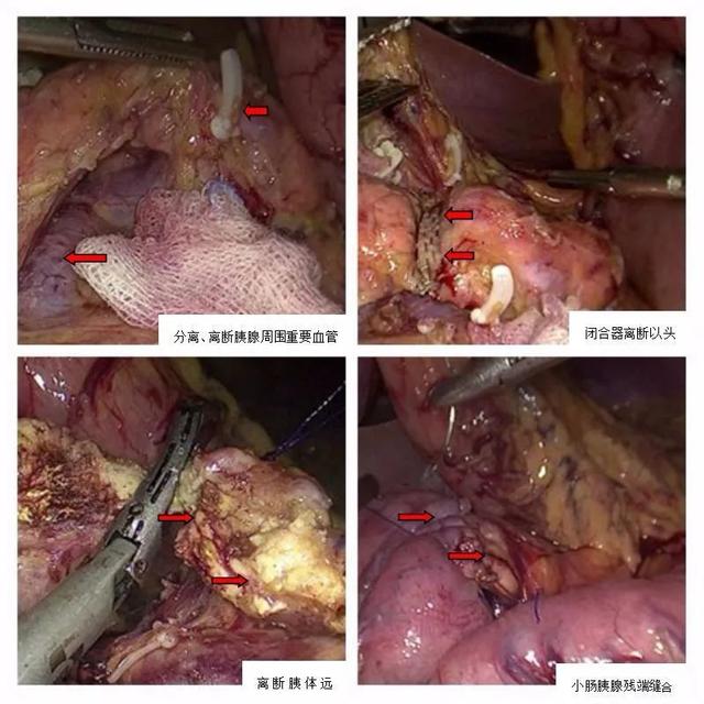 同济大学附属同济医院普通外科完成全腔镜下中段胰腺肿瘤切除术