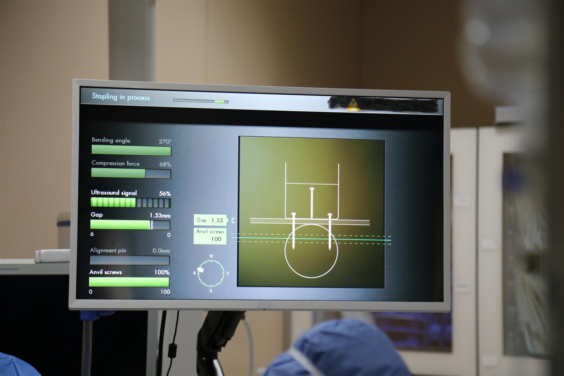 国产胃镜都有什么品牌胃食管反流手术如“胃镜”简单，费用少一半：市一医院完成首例国产MUSE术_https://www.jmylbn.com_新闻资讯_第2张