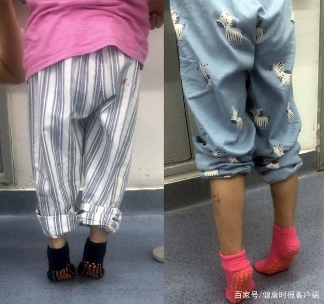 龙凤胎脑瘫兄妹术前的尖足情况(受访者供图)