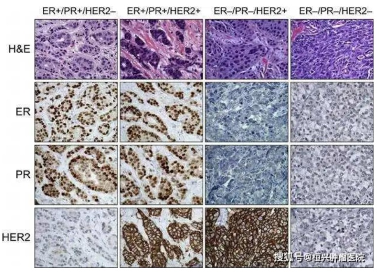 揭开粉红杀手乳腺癌的神秘面纱一文读懂乳腺癌