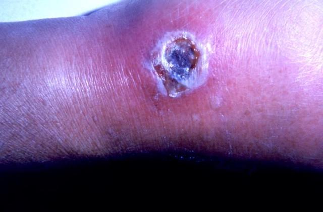 皮肤炭疽感染所引起的病灶,图片来自于网络