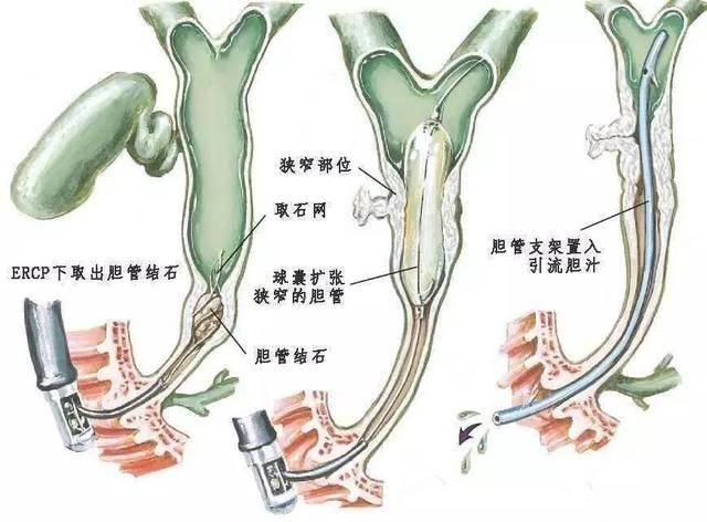 ercp行胆道取石术及胆管支架引流术示意图
