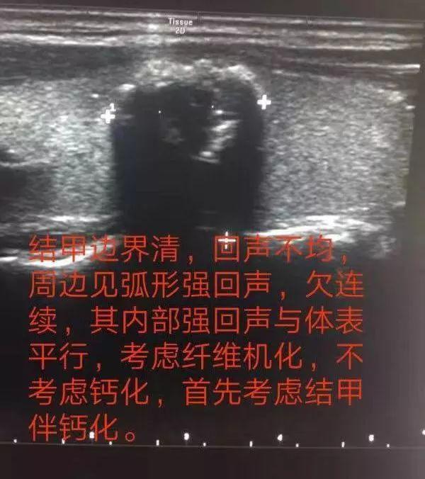 当甲状腺结节遇上钙化就是癌