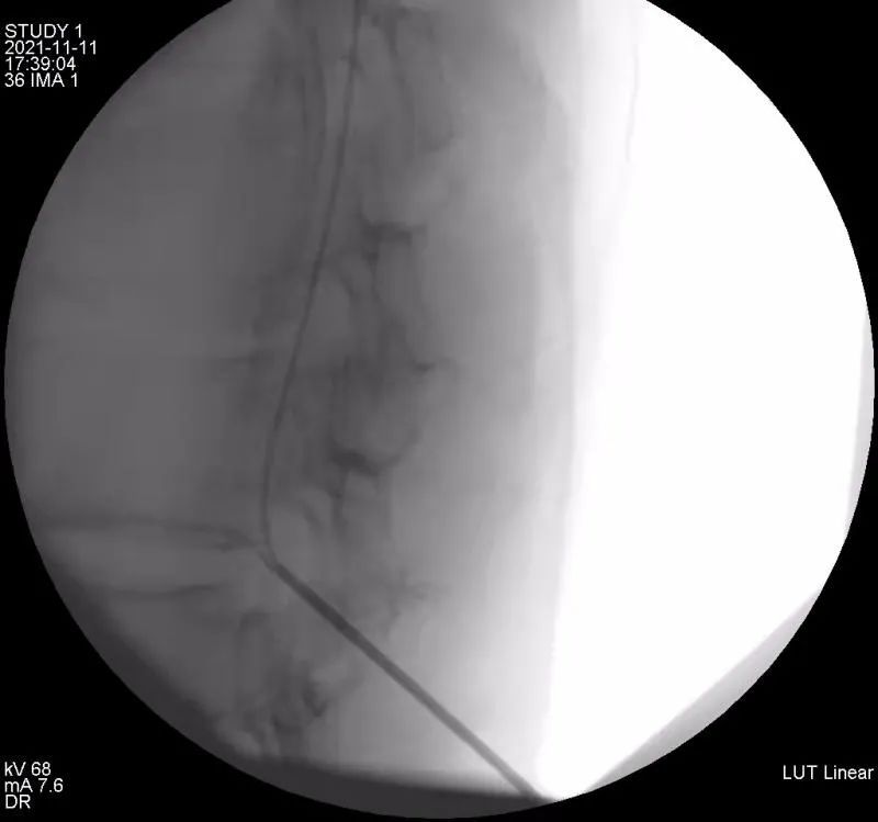 【病案现场】晚期癌痛治疗利器:鞘内镇痛泵植入术——同济大学附属