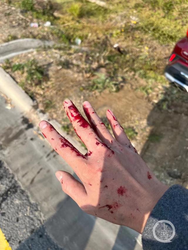 11月16日,吴宗涛被撞受伤的手部图片来源/受访者供图