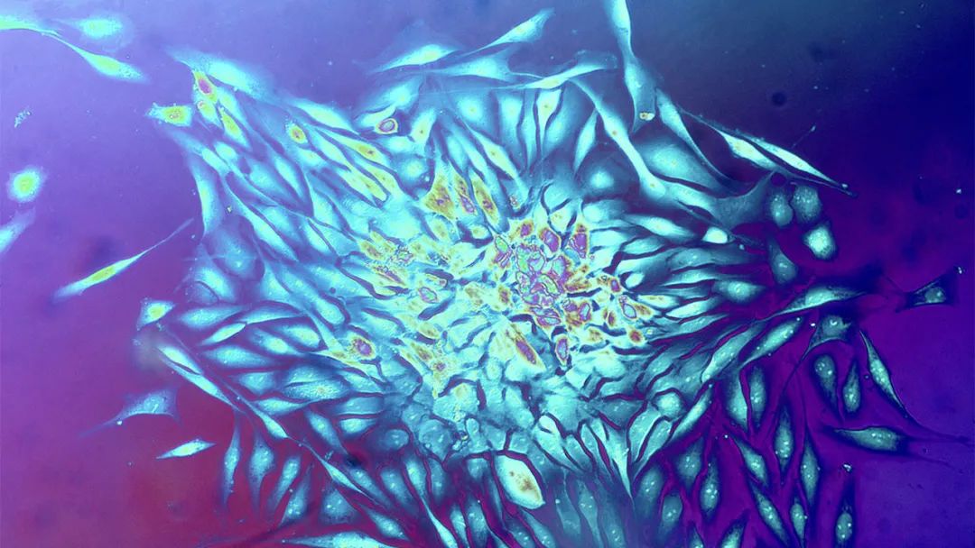 人乳腺癌细胞。图源/CECIL H. FOX