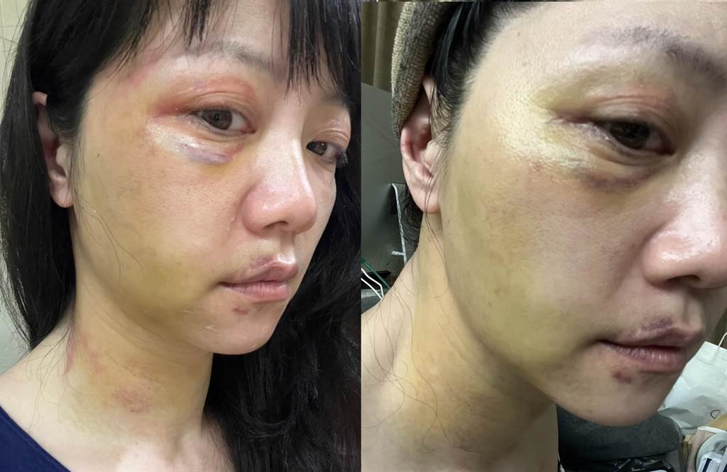 高嘉瑜曝光受傷圖片