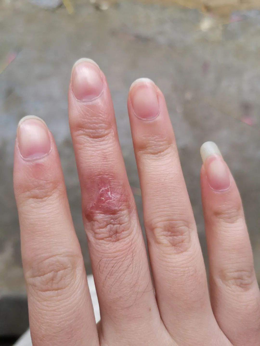 温州姑娘洗虾手指被扎伤后无法愈合原来是感染了一种罕见细菌