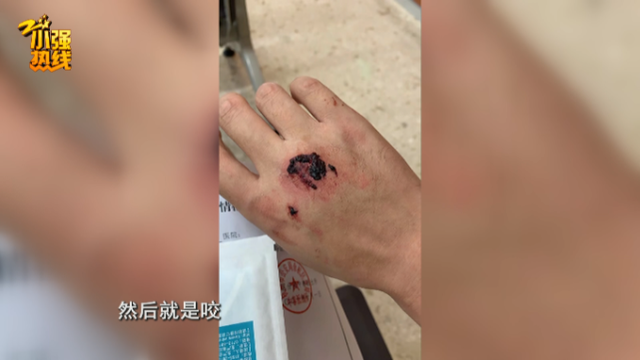 在黄先生当时被咬的照片上可以看到,面部和手腕咬痕