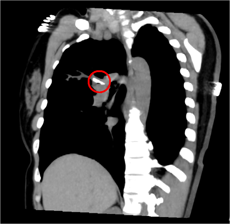 吓坏咳嗽咯血8个月以为是肺部肿瘤结果竟是