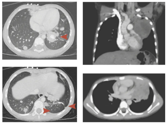 左、右2列分别为病例1和病例2中的胸部成像。左列图中红色箭头标示了病例1肺部的癌细胞群。图片来源：Arakawa et al., NJEM