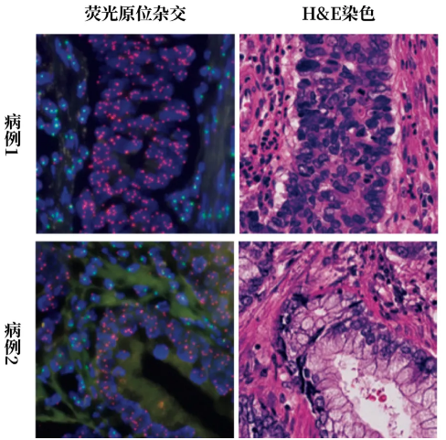 病例1、2的许多肺癌细胞只带X染色体（荧光原位杂交图像中标记为粉色）。图片来源：Arakawa et al., NJEM，翻译制图：罗丁豪