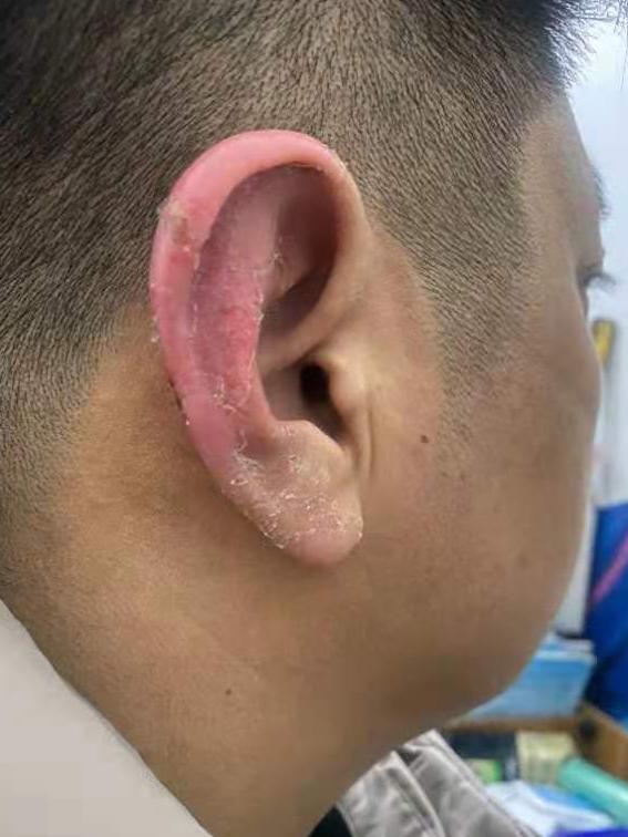 李强在夜巡中因气温过低耳朵被冻伤