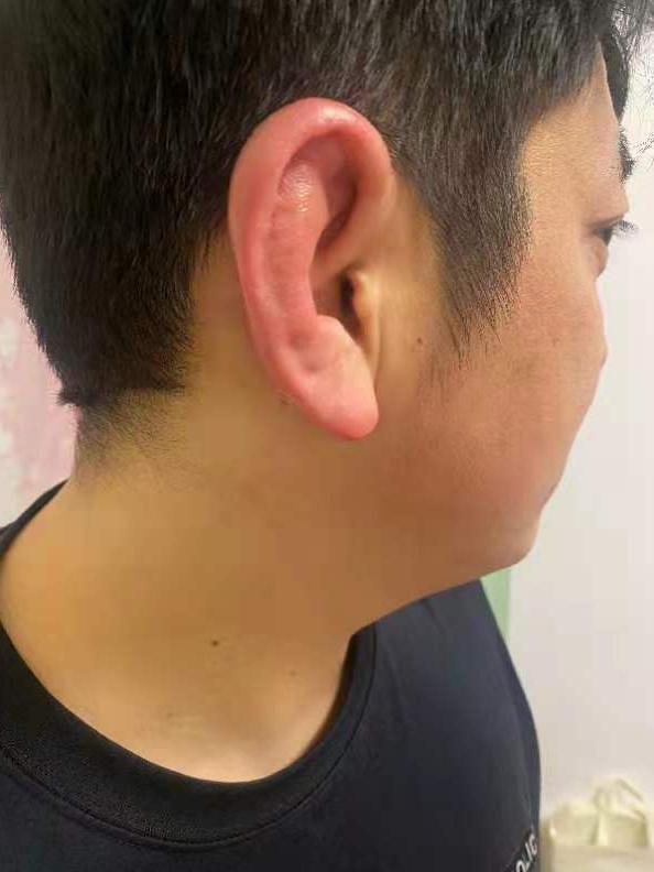 李强在夜巡中因气温过低耳朵被冻伤