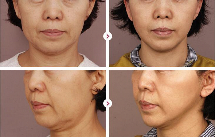 春节不打烊的轻医美是打开千亿市场的金钥匙吗