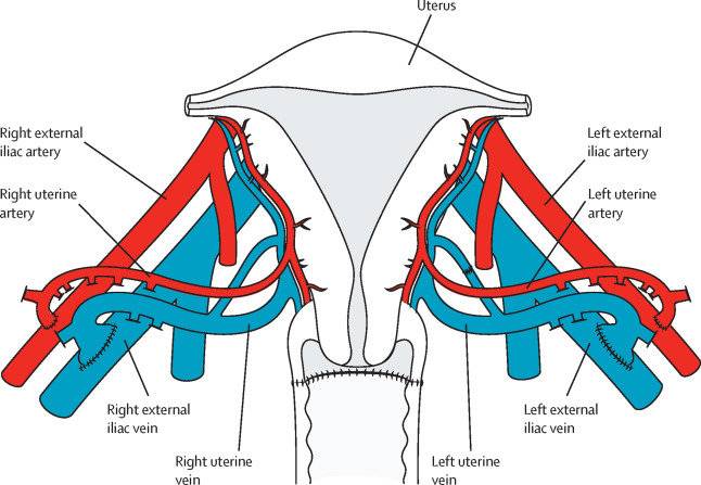 移植子宫的血管连接示意图，图源：柳叶刀