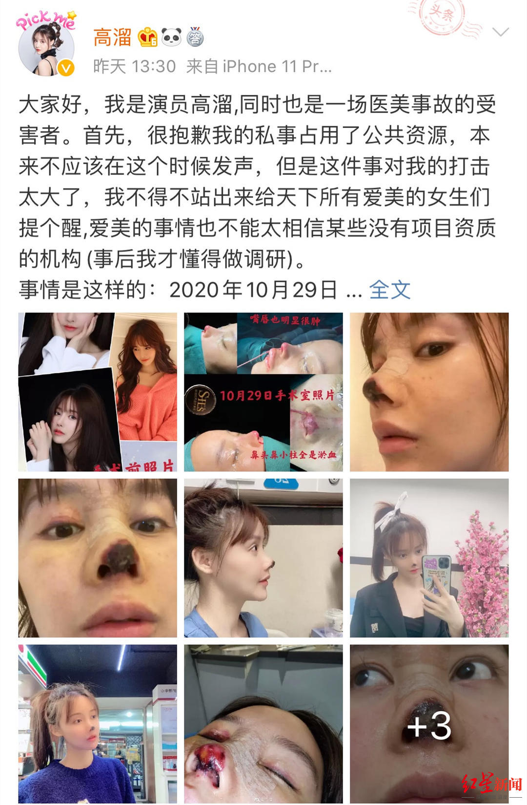 演员高溜自曝整容失败鼻尖坏死涉事医院相关人员 正走司法程序 含视频 手机新浪网 演员高溜自曝整容失败鼻尖坏死涉事医院相关人员 正走司法程序 含视频 手机新浪网