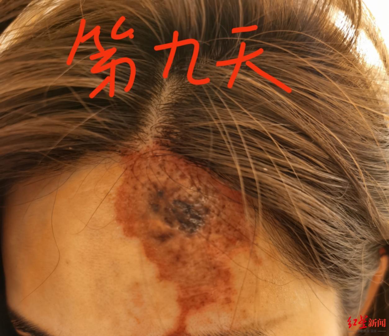 心理培训师注射胶原蛋白美容毁脸医院属小概率并发症赔偿未达成一致