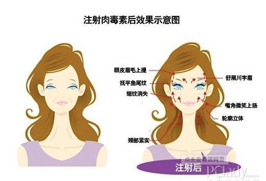 医美系列之返老还童术肉毒素注射