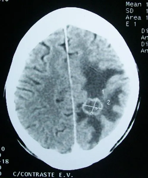 通过CT确认的脑部肿瘤。图片来源：wikipedia