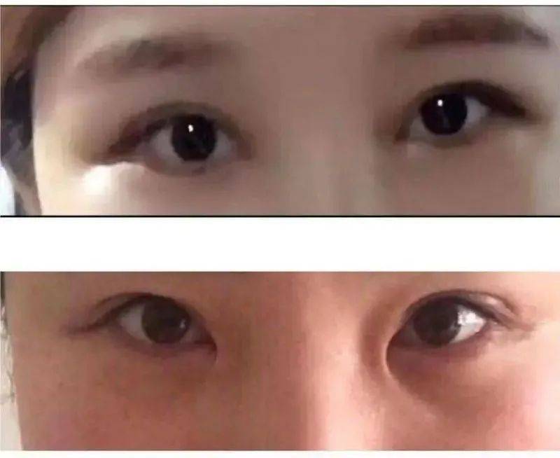 孙雨在来美安术前(图1)术后(图2)眼睛对比.图片由受访者提供