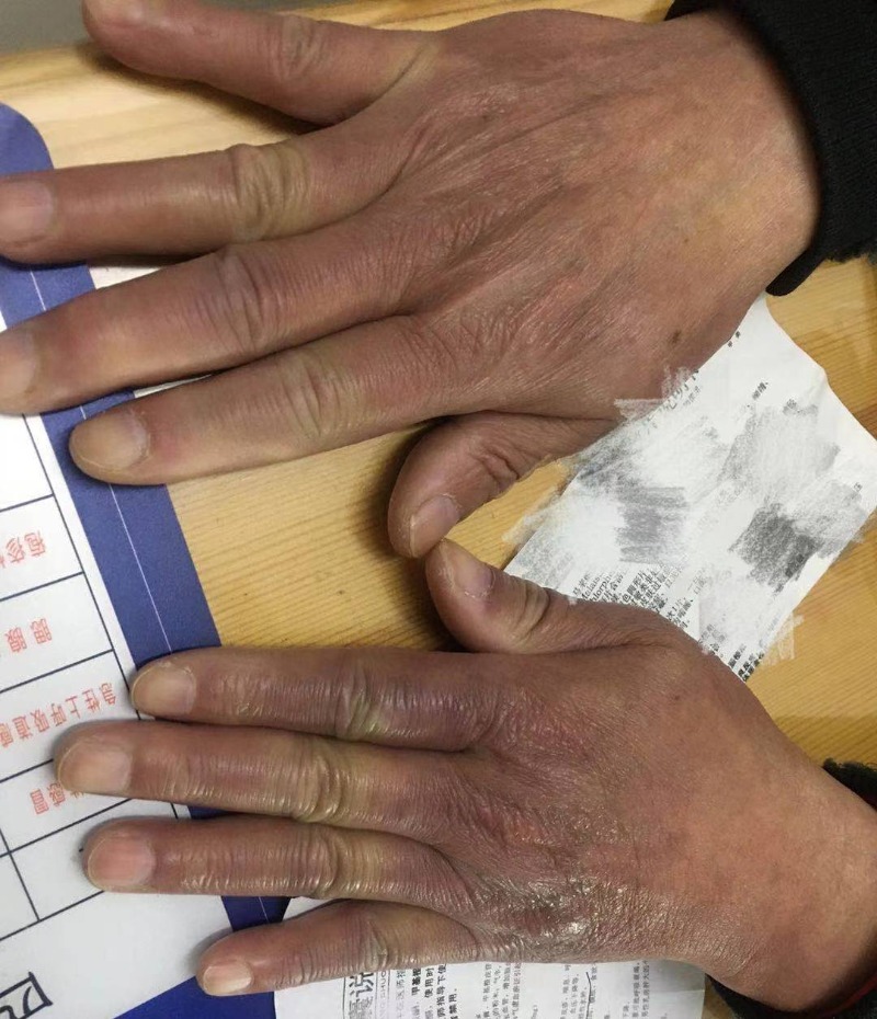 7旬偏瘫爹爹急复健,服药活血化瘀竟致手部水肿|糖尿病_新浪财经_新浪