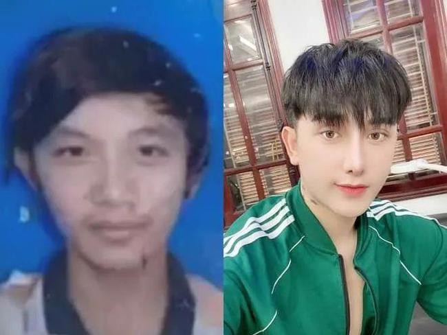 小伙因长得丑处处碰壁怒花11万整容成帅哥