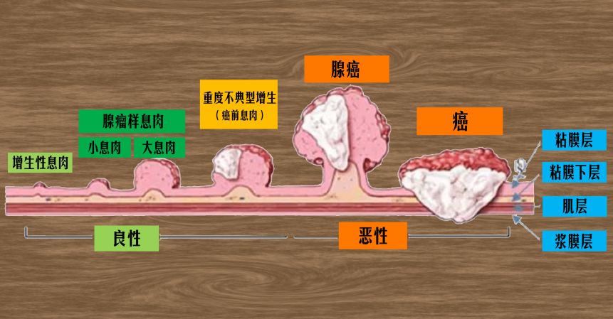 息肉癌变过程