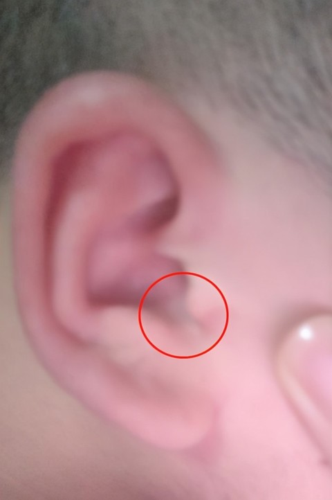 使用oppo耳机耳朵会发炎流脓