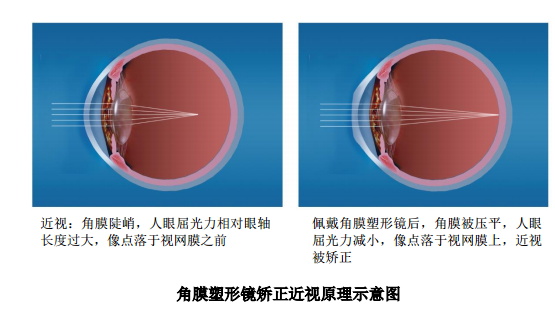 (图片来源:爱博医疗招股书)