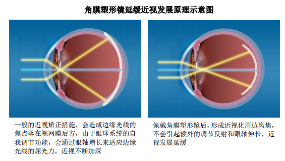 (图片来源:爱博医疗招股书)