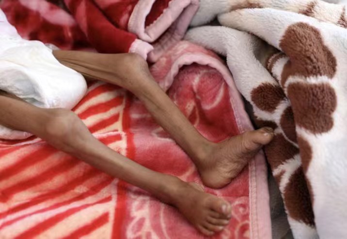△2020年10月27日，一名营养不良的女孩躺在也门萨那一家医院的病床上。（图片来源：路透社）