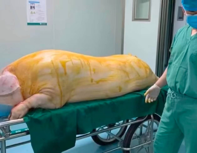 河南周口港区医院为烧伤病人手术移植猪皮惹争议医院回应取皮后猪被拉