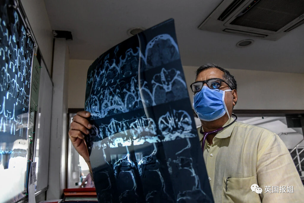 3万人感染,面部流血摘眼切鼻难保命|霉菌|印度|新冠肺炎_新浪新闻