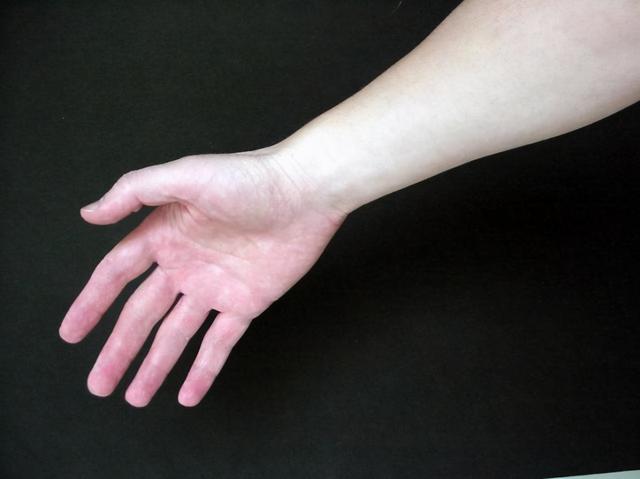 印度17岁男孩参加生日聚会疑被注射毒品,最终不得不截肢