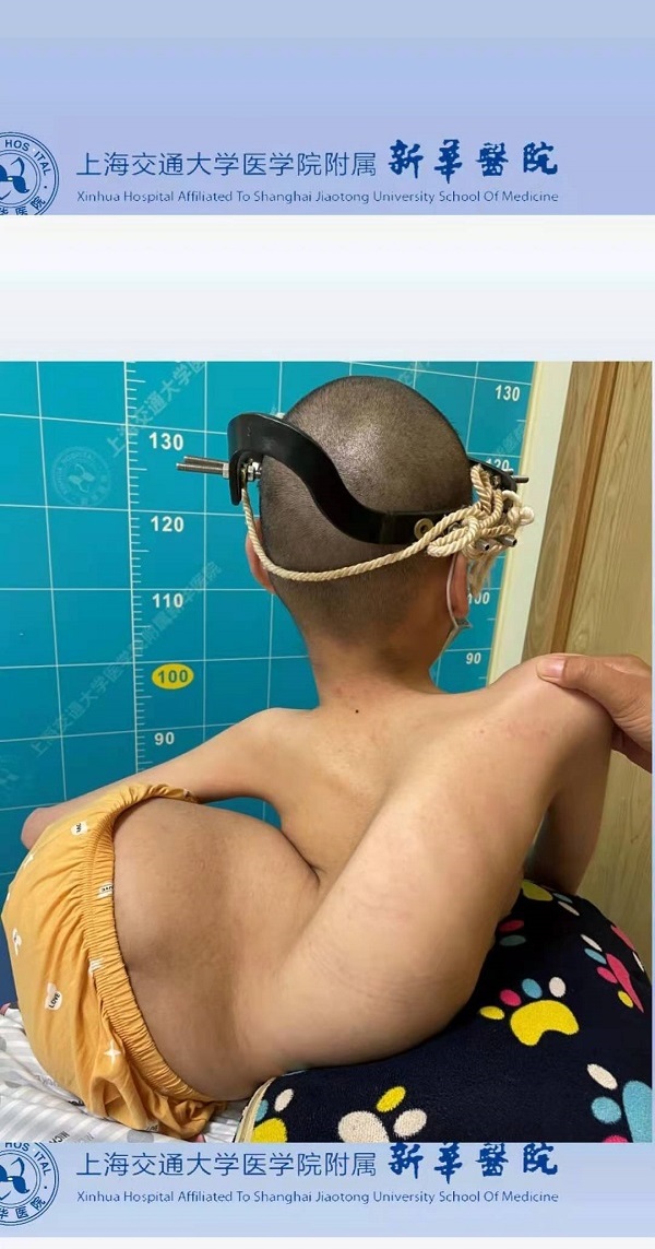 新华医院完成严重脊髓性肌萎缩症sma患儿脊柱矫正术国