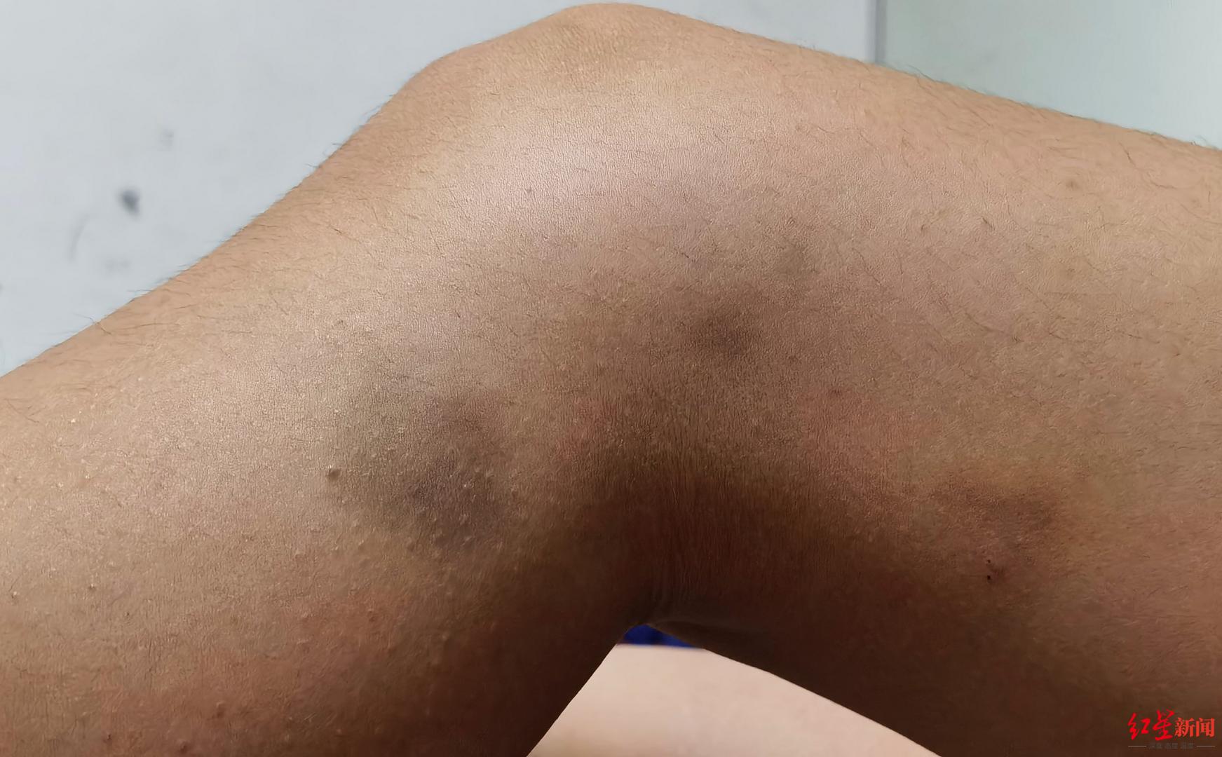 女孩舞蹈培训后多处淤青 家长质疑被体罚 老师:用鼓槌拍打纠错